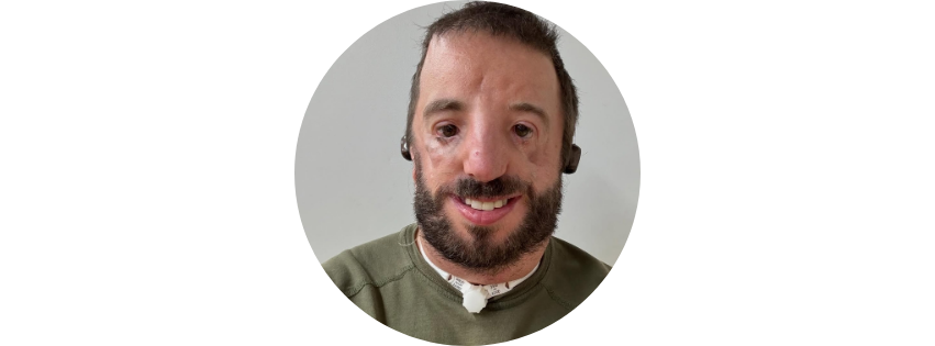 Kyle Mersola - Life with Treacher Collins Syndrome