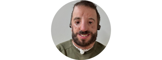 Kyle Mersola - Life with Treacher Collins Syndrome